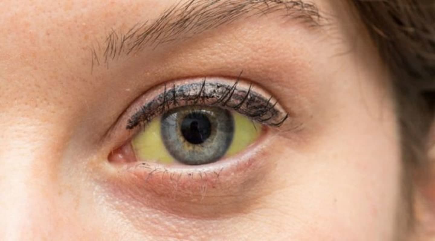 Mês de julho é marcado por luta contra a hepatite