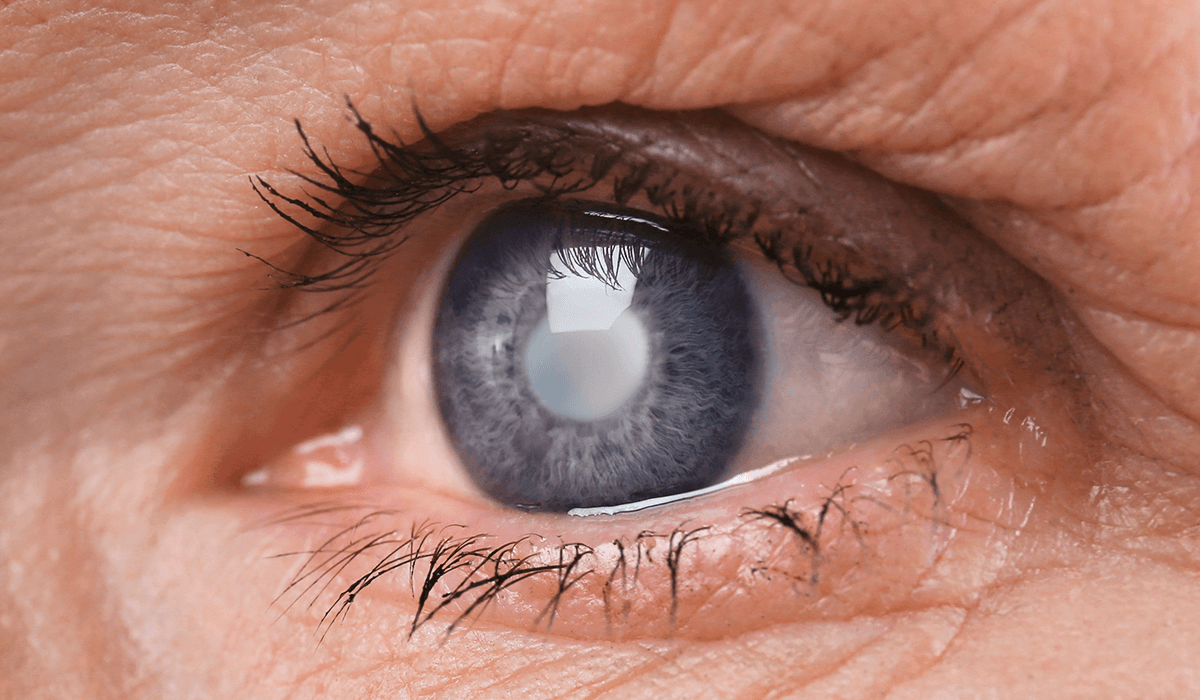 Cerca de 200 tubaronenses serão beneficiados em mutirão de cirurgias de catarata