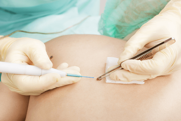 Mutirão de oncologia será realizado no HNSC