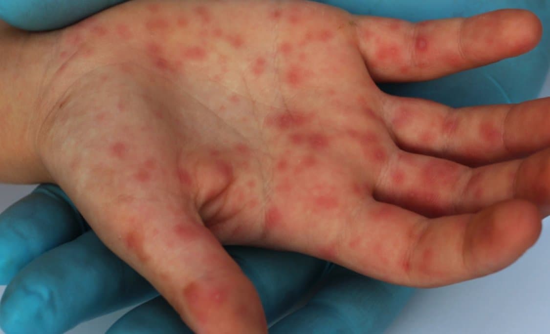 Doenças infectocontagiosas serão tema de capacitação de médicos e enfermeiros