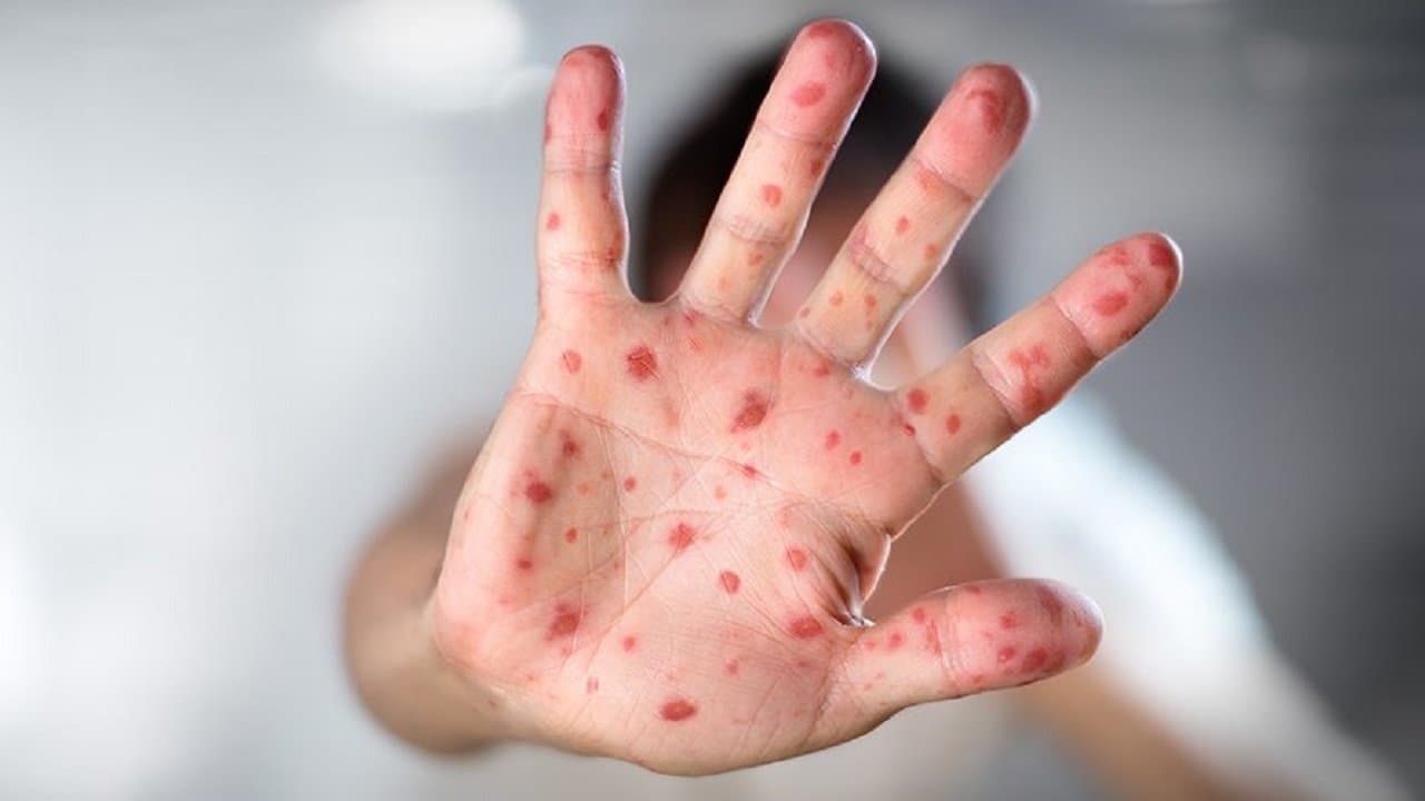 Síndrome entre crianças pequenas liga o alerta nas escolas de Tubarão