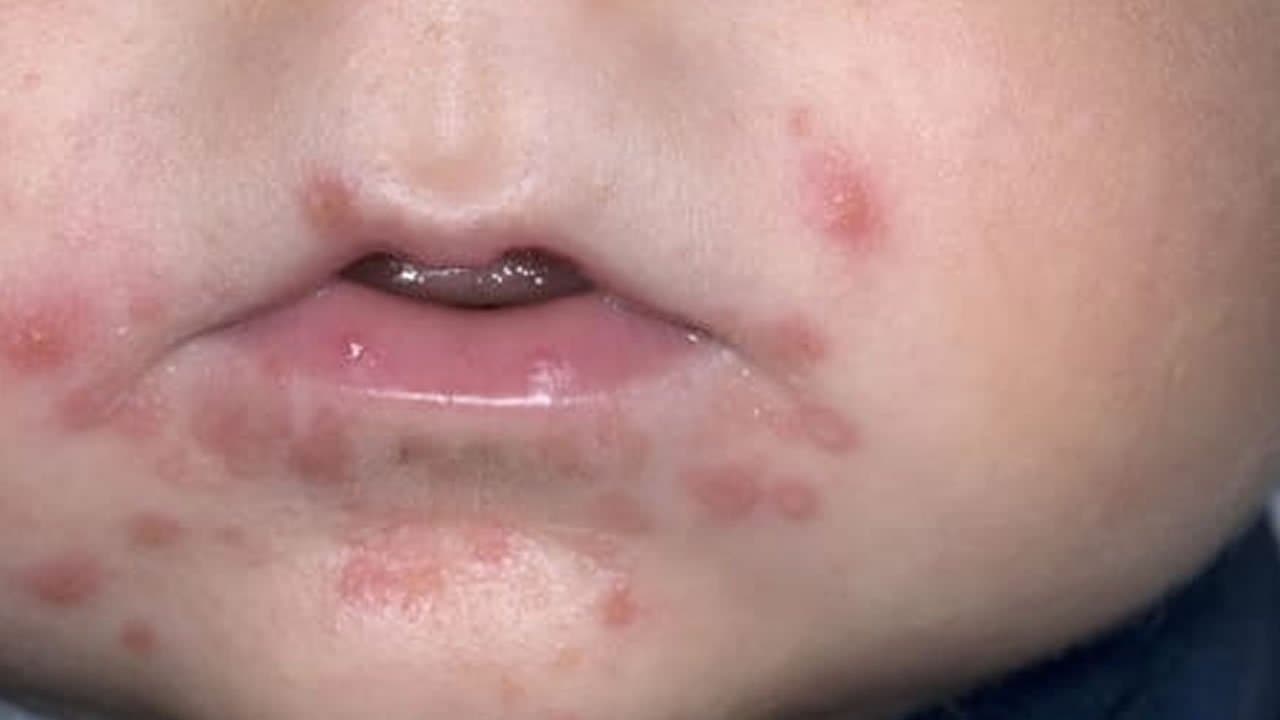 Mão-pé-boca: alerta para os pais!