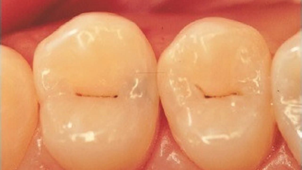 O que é um “ponto preto” no seu dente?