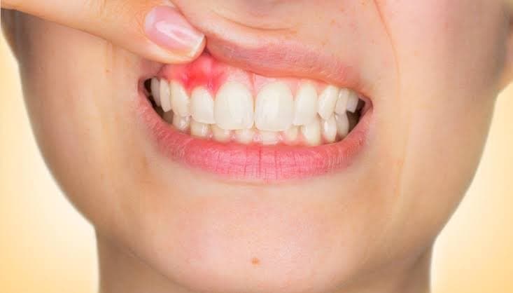 O que causa o abcesso dentário