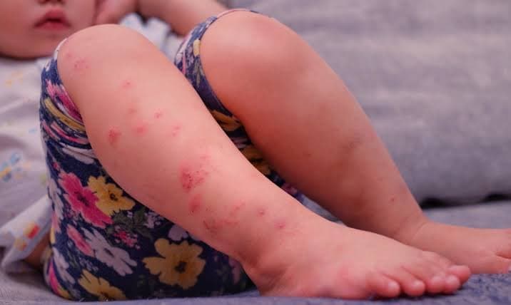 Atividades em creche são suspensas após casos da síndrome mão-pé-boca