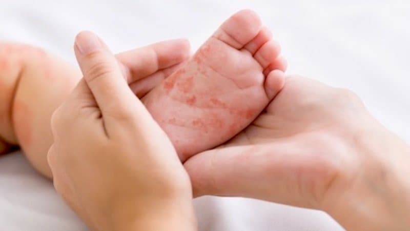 País recupera certificado de eliminação do sarampo após cinco anos