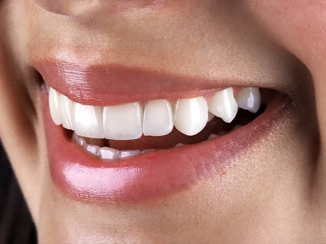 Resina composta na Odontologia Estética