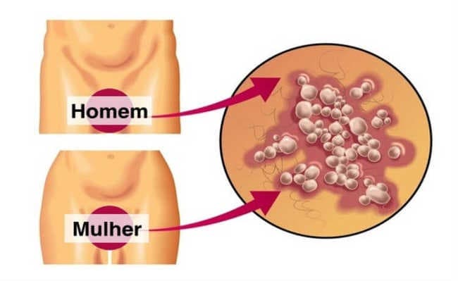 Sífilis é causa de alerta em Santa Catarina