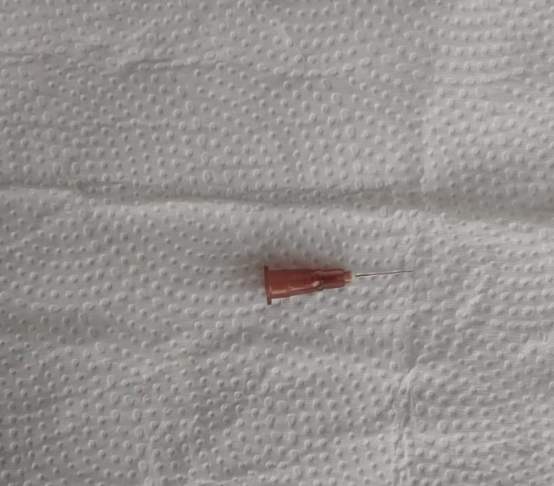 Polícia investiga caso de agulha esquecida em criança em Armazém