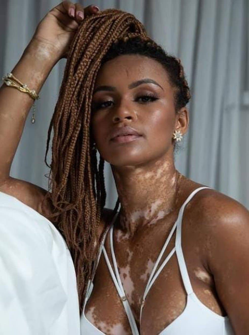 Vitiligo: entenda a doença de pele que afeta Natália do BBB e 1% da população
